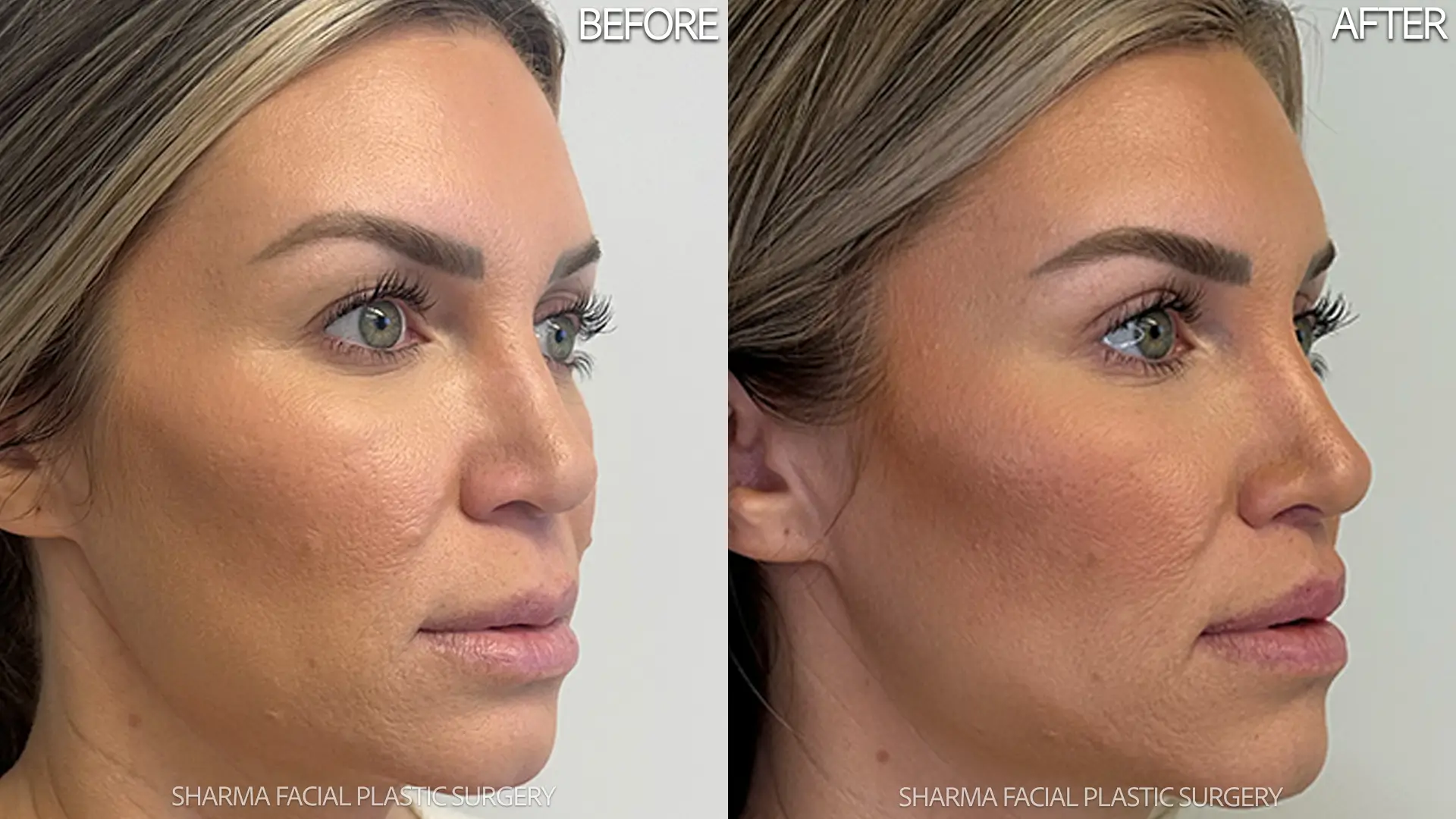 Lip Augmentation - Case 1