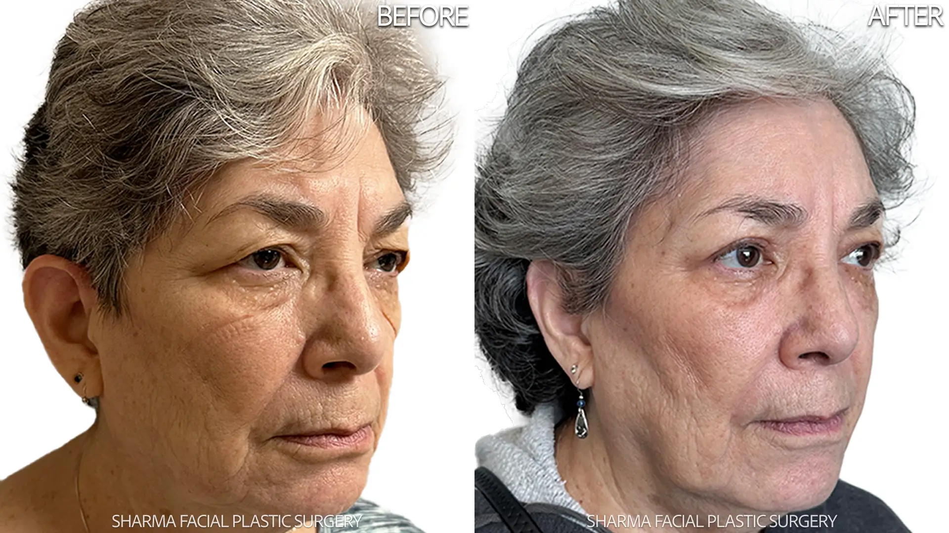 Endoscopic Brow Lift Upper Blepharoplasty and Ptosis Repair Case 4