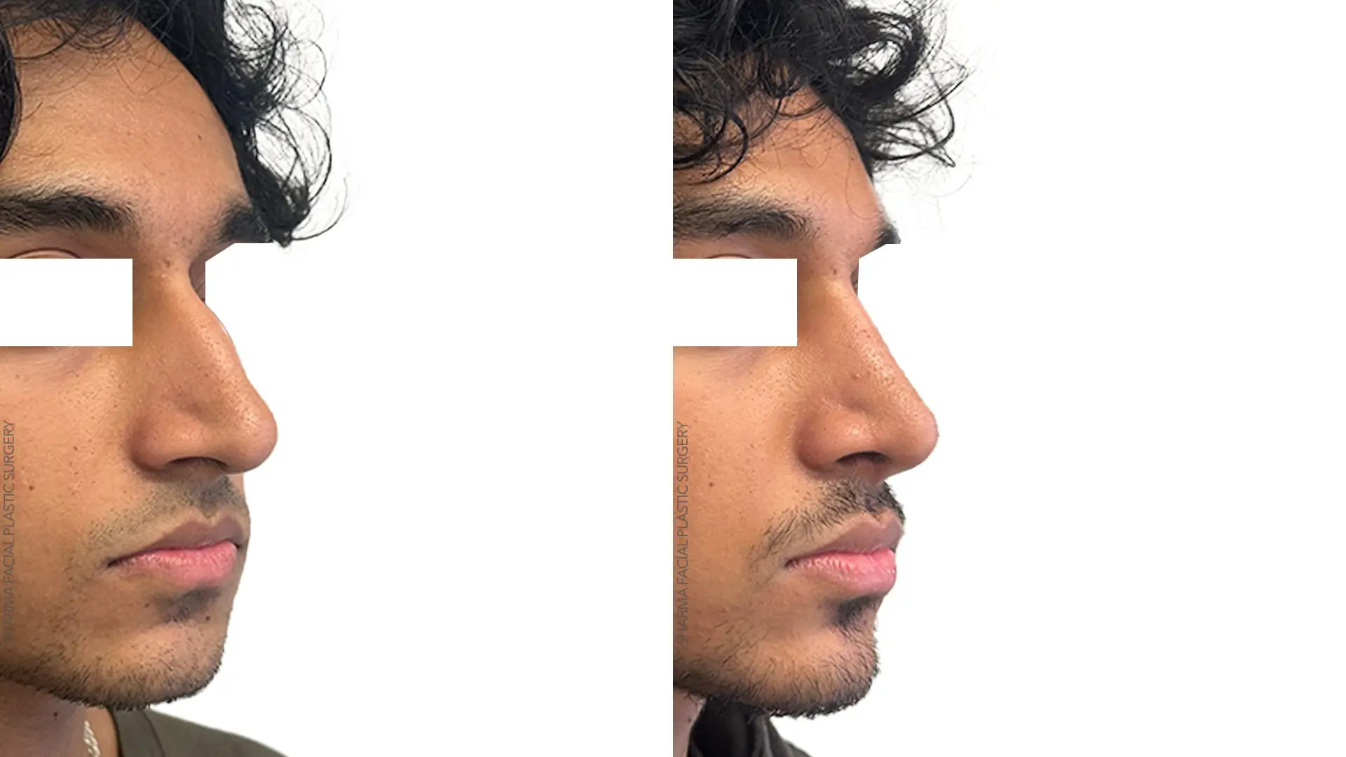 Rhinoplasty (Male) - Case 3