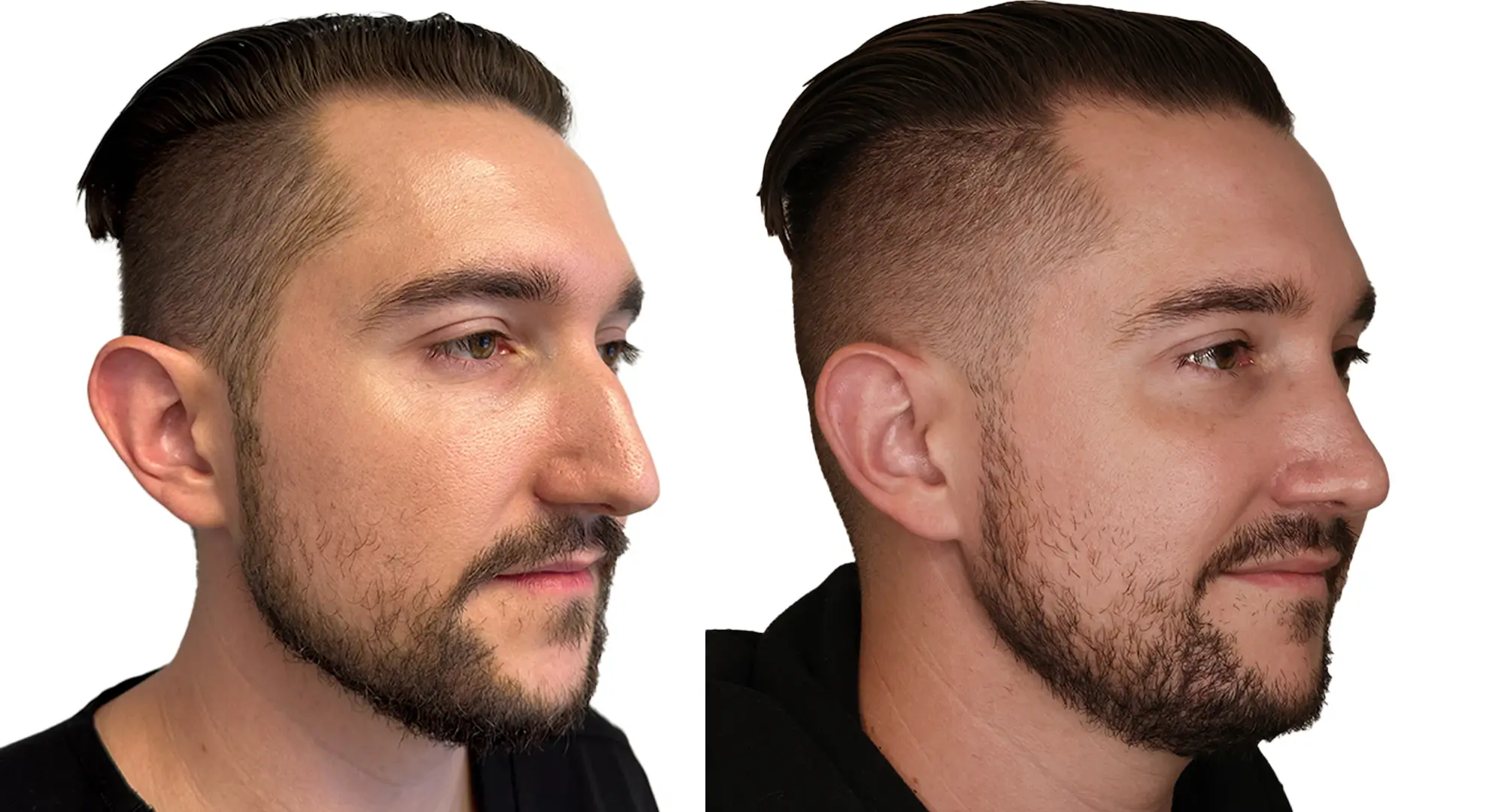 Rhinoplasty (Male) - Case 2